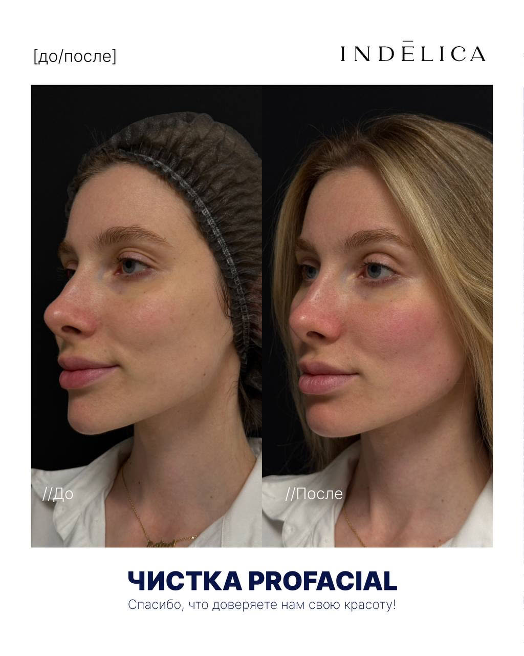 Чистка ProFacial · до / после