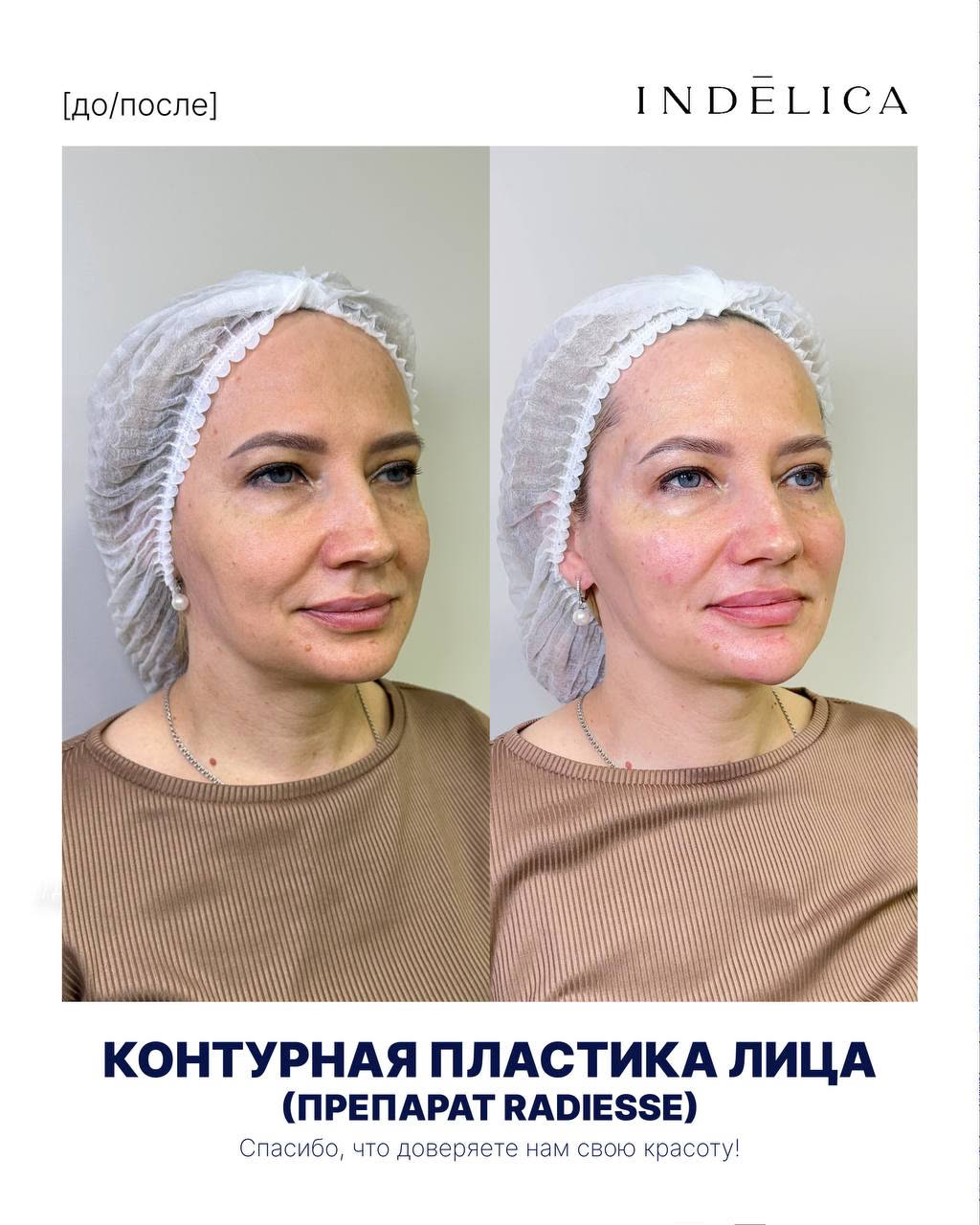 филлеры/контурная пластика · до / после