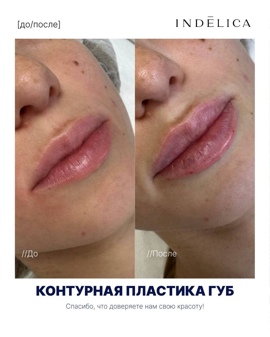 филлеры/контурная пластика · до / после