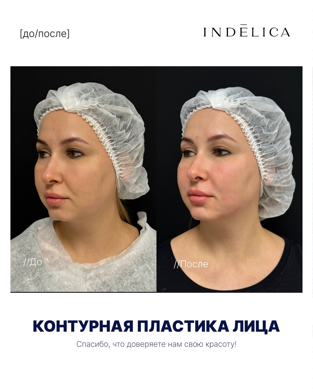 Контурная пластика лица · до / после