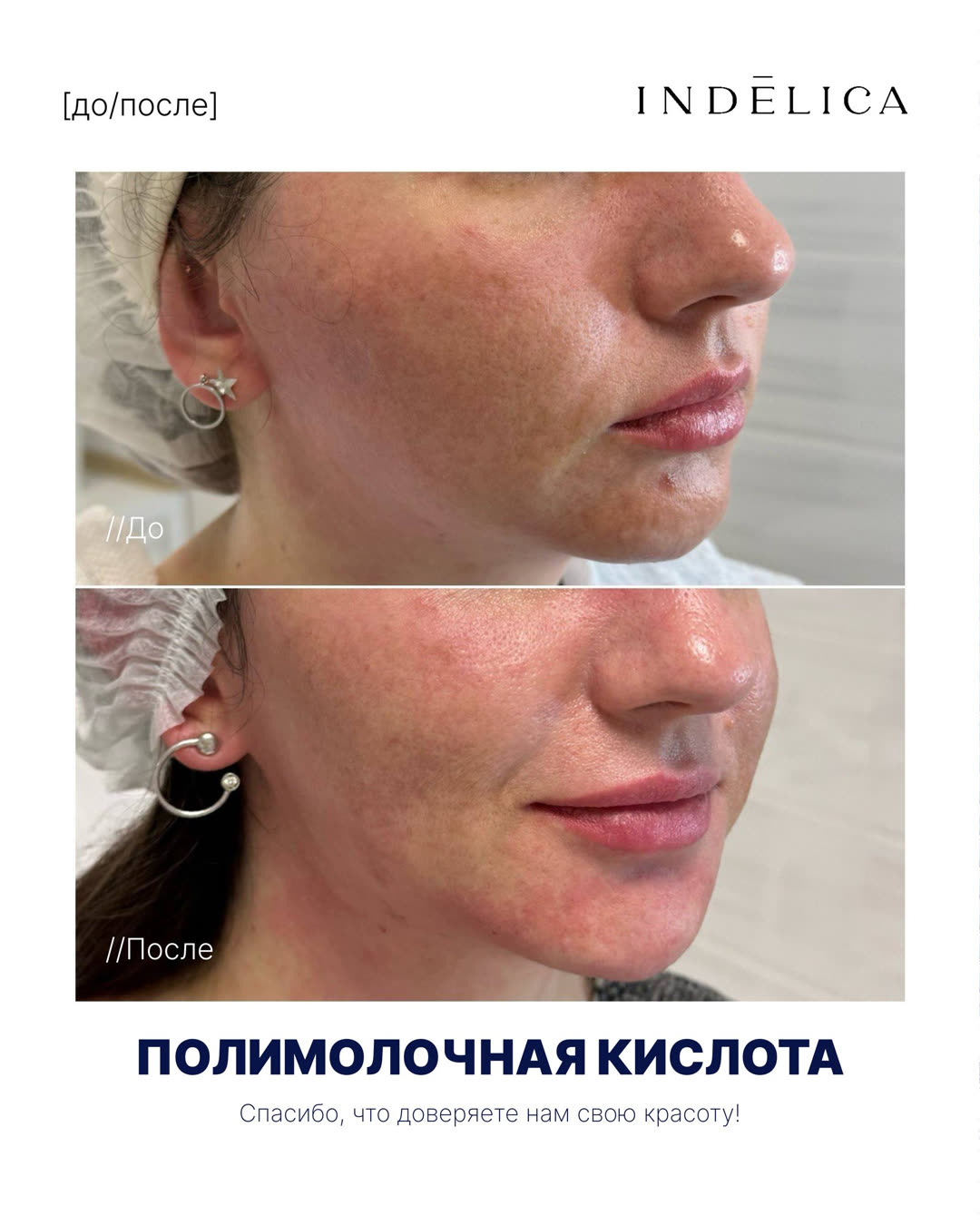 коллагенотерапия · до / после