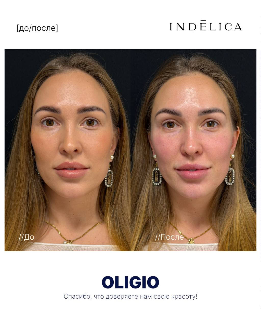 Oligio RF · до / после