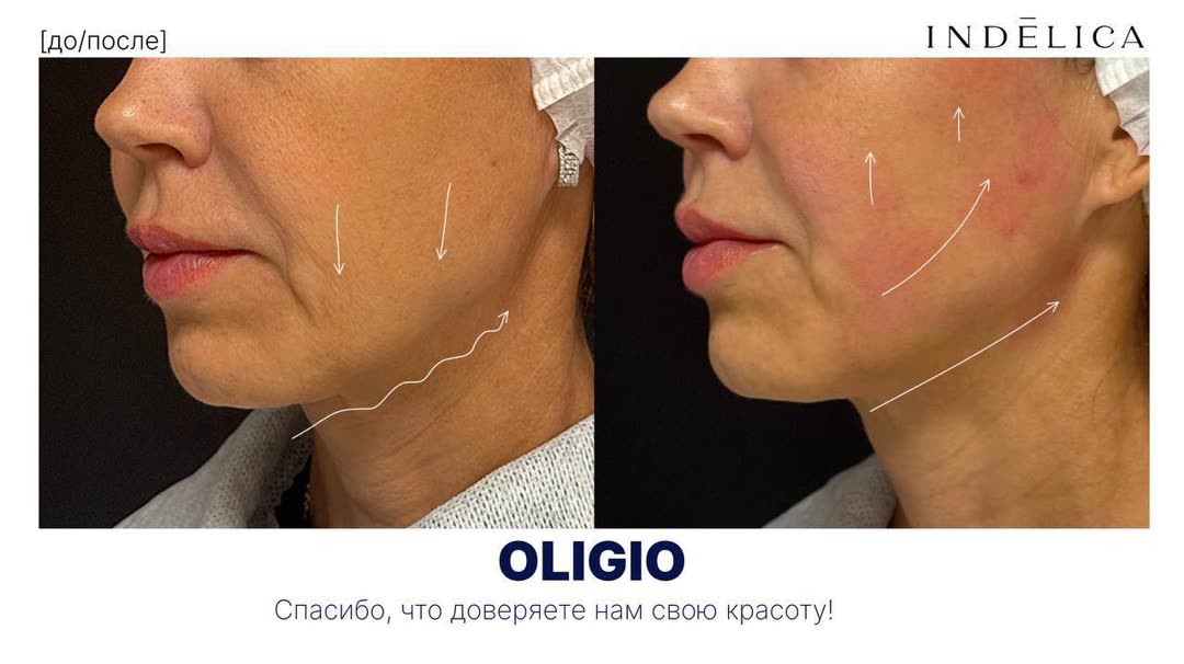 Oligio RF · до / после