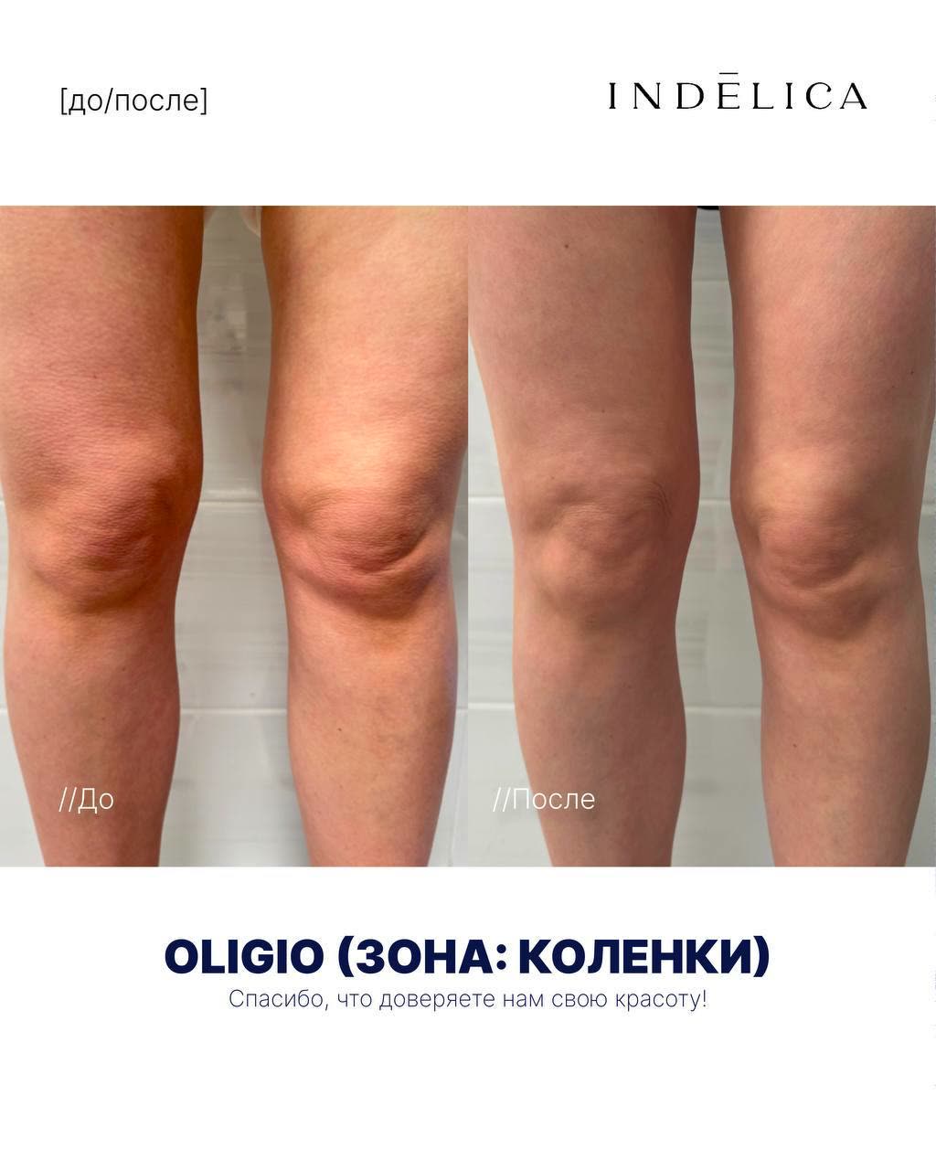 Oligio RF · до / после