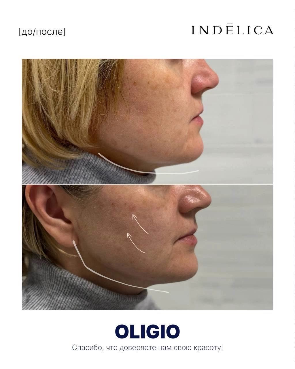 Oligio RF · до / после