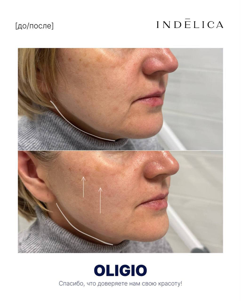 Oligio RF · до / после