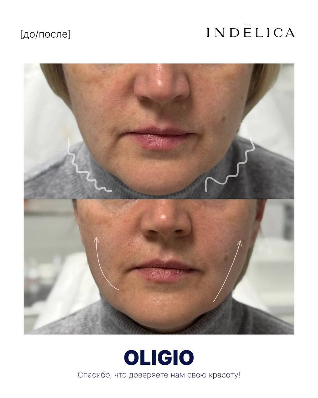 Oligio RF · до / после