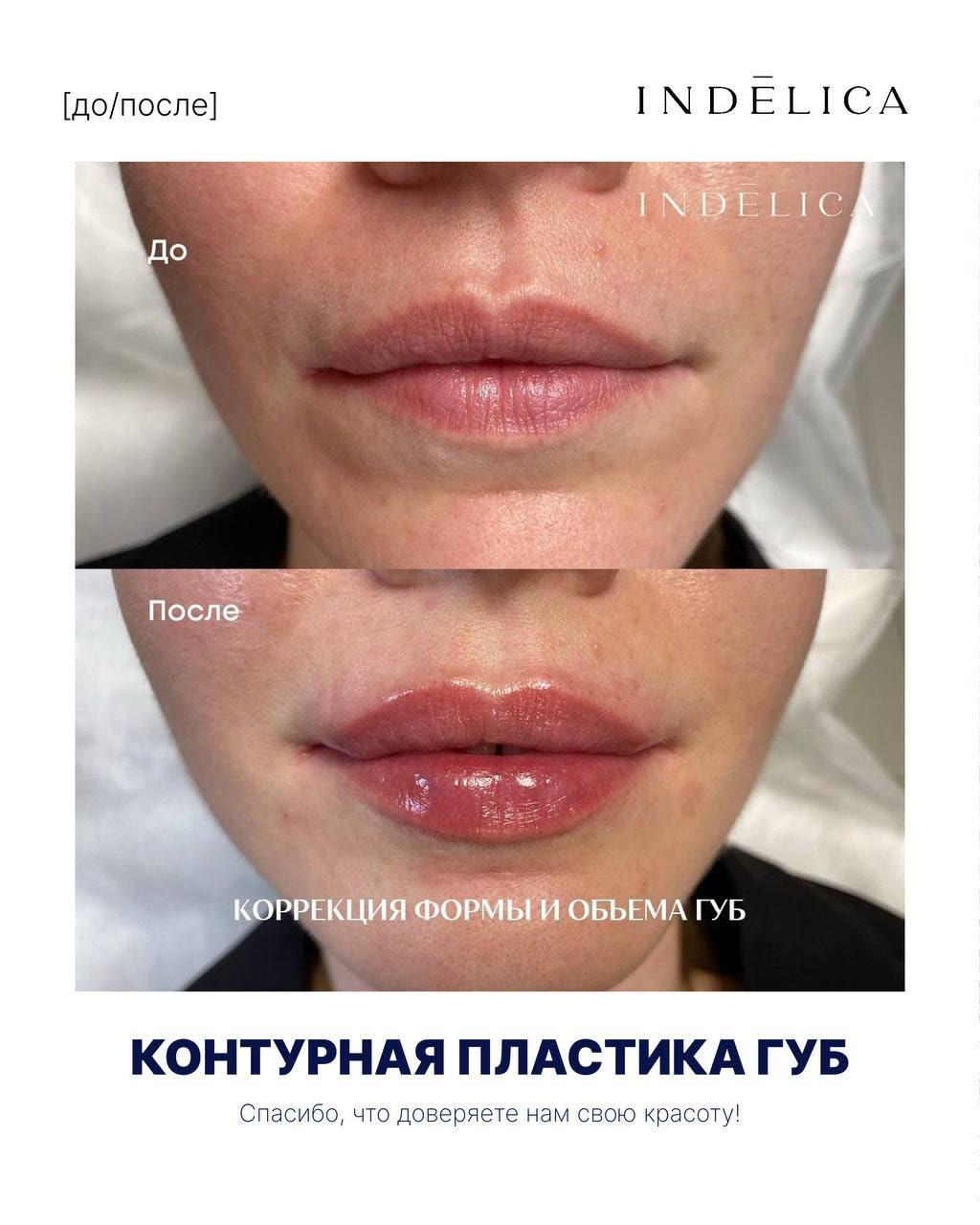 увеличение губ · до / после