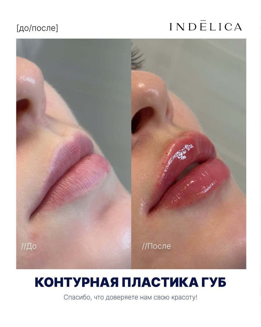 увеличение губ · до / после