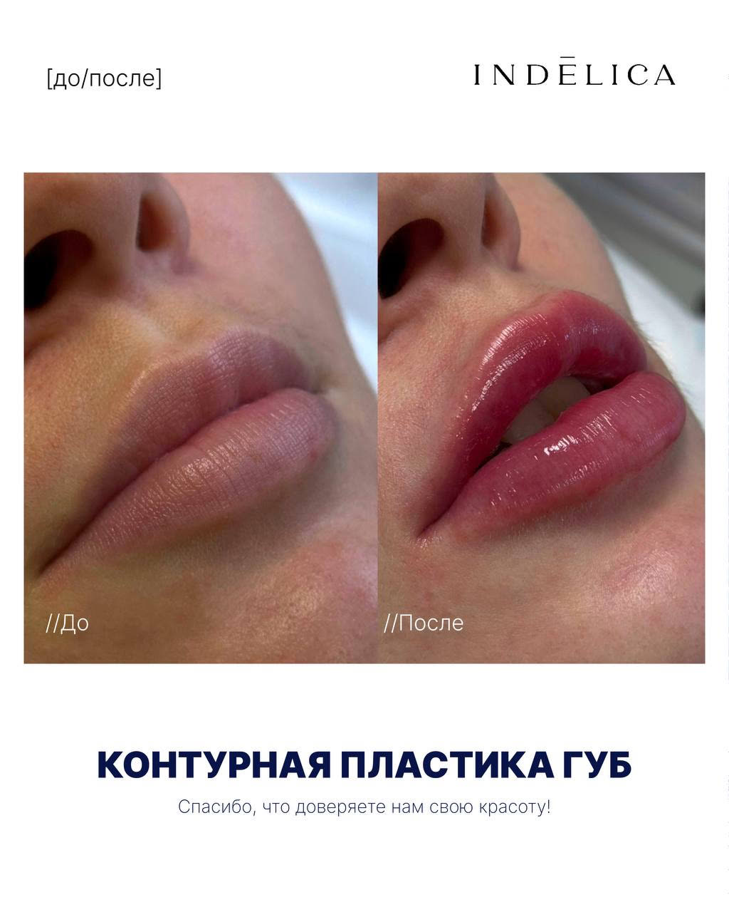 увеличение губ · до / после