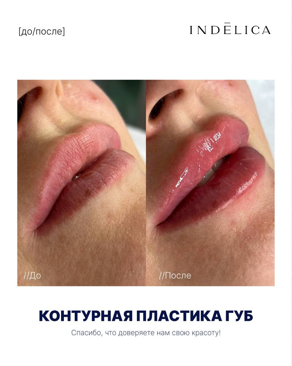 Контурная пластика губ · до / после