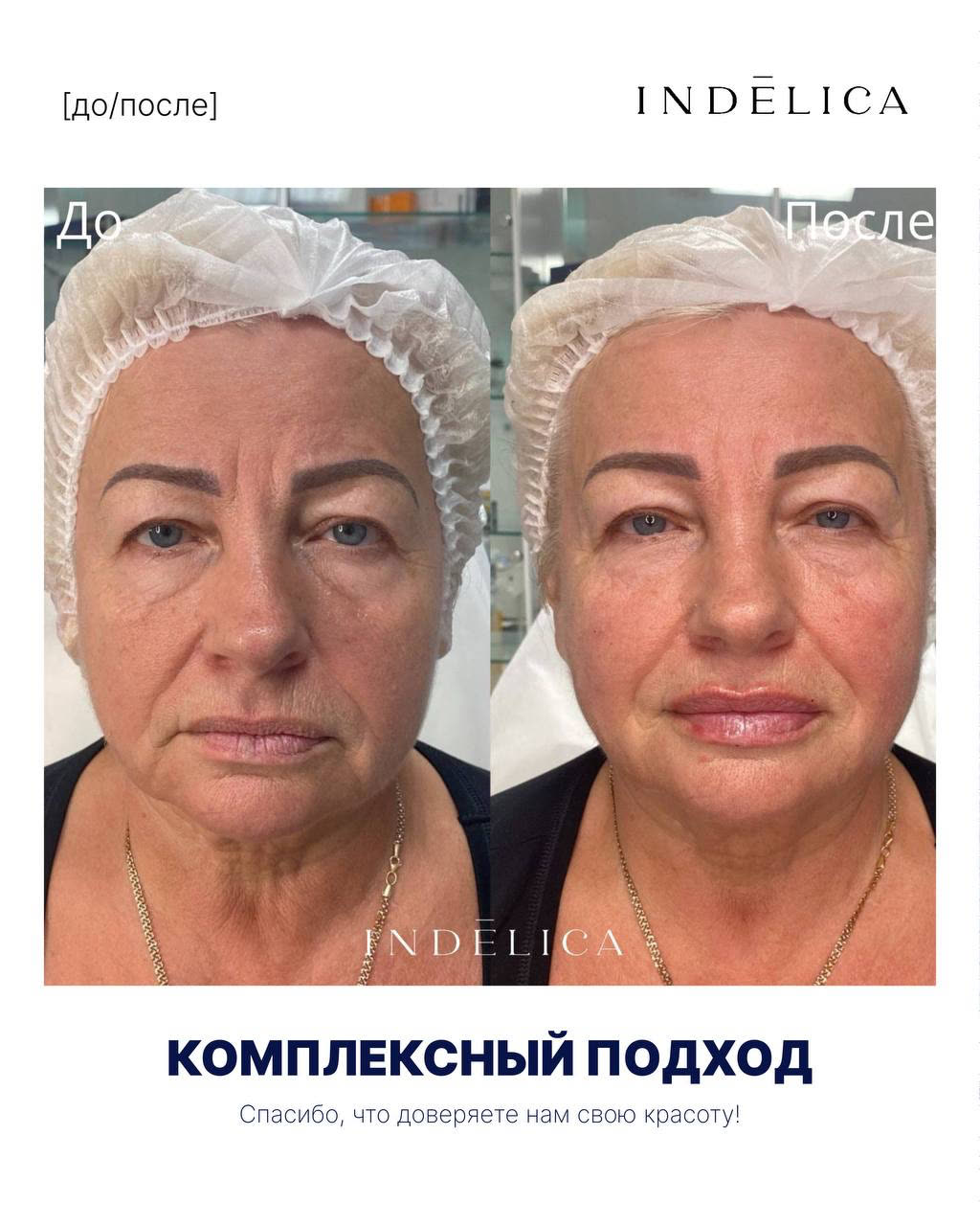 Комплексный подход · до / после