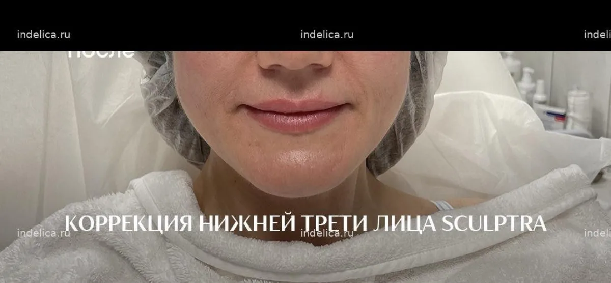 Фото до — коррекция нижней трети лица филлером — клиника Инделика Самара