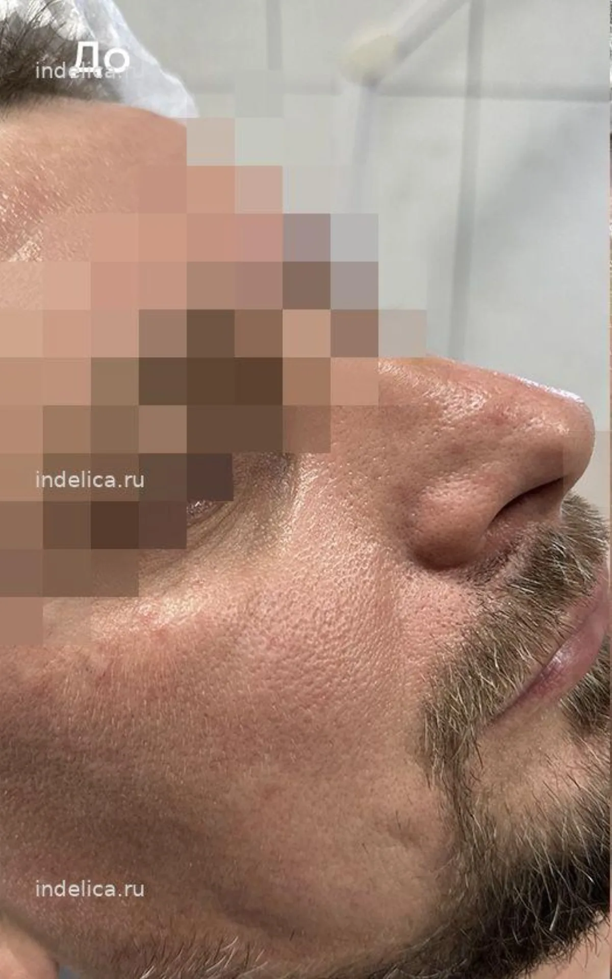 Фото до — коррекция носослёзной борозды филлером — клиника Инделика Самара