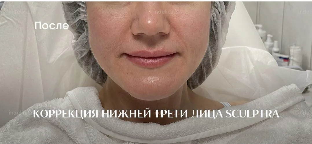 Лицо до контурной пластики филлерами — поплывший овал, выраженные носогубки