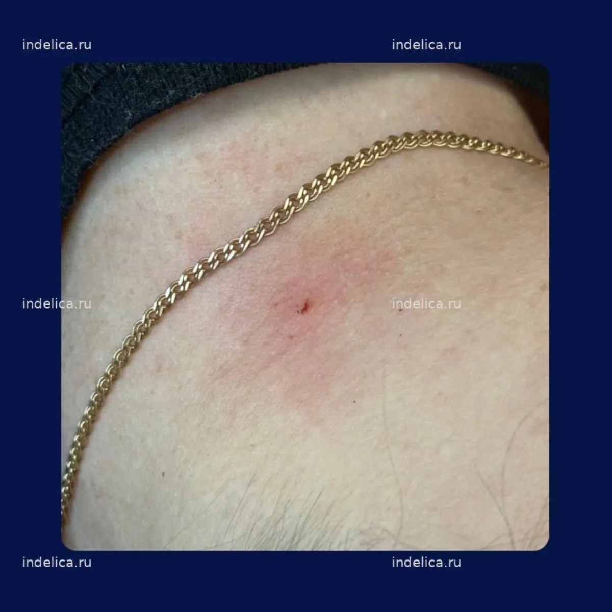 Фото после — удаление новообразования лазером DERMABLATE — клиника Indelica Самара