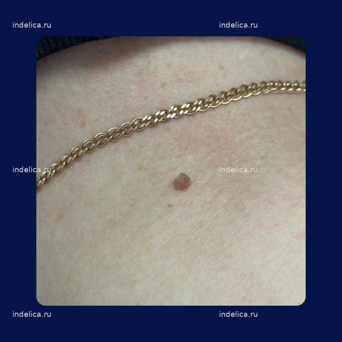 Фото до — удаление новообразования лазером DERMABLATE — клиника Indelica Самара
