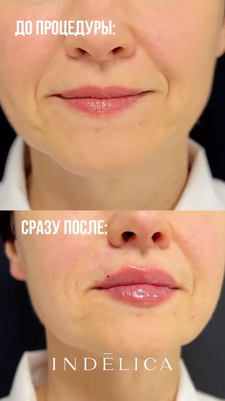 Ботулинотерапия · до / после