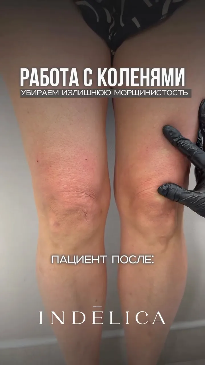 Oligio RF · до / после