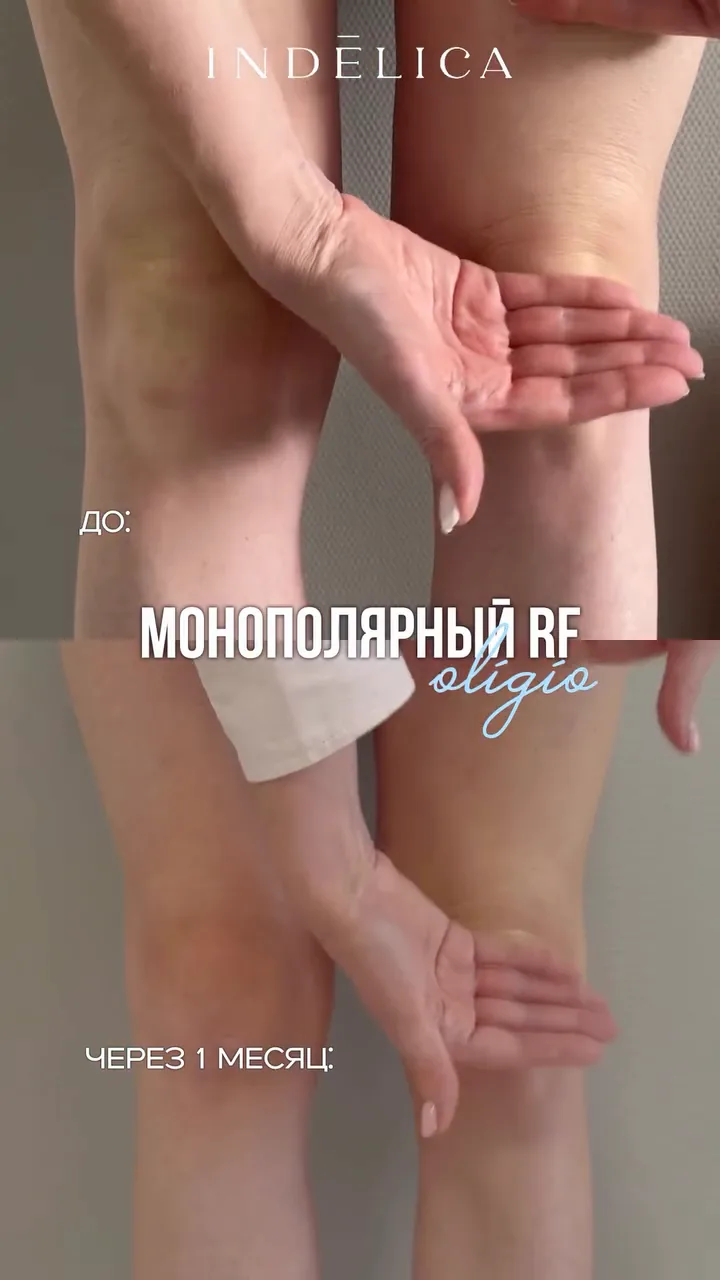 Oligio RF · до / после