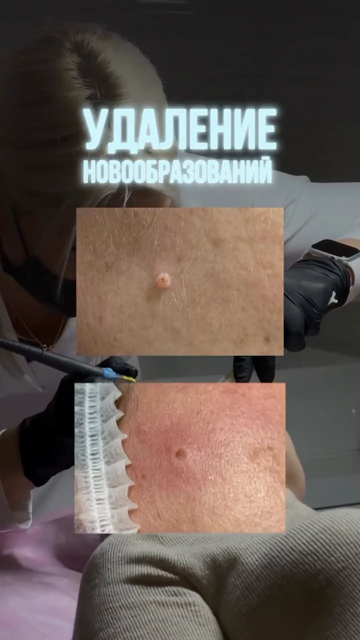 Удаление новообразований